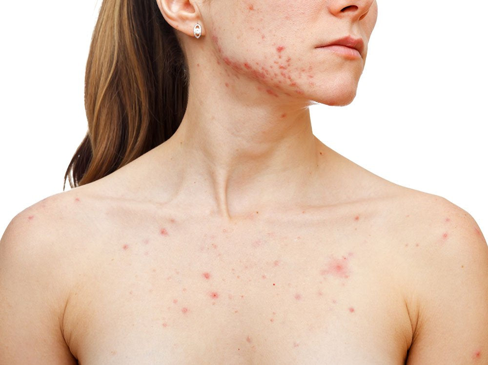 Is Your Acne Genetic?